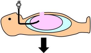 胃瘻の造設：カテーテル貫通孔を造設