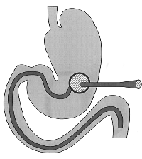 経胃瘻的空腸栄養チューブの模式図/内視鏡的空腸瘻（ＰＥＪ：Percutaneous Endoscopic Jejunostomy）